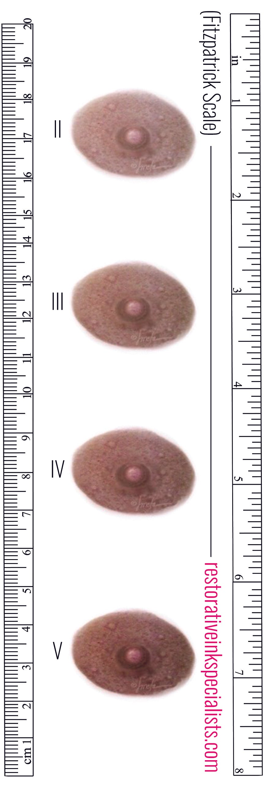 Fitzpatrick Scale Areola Color Ruler MALE